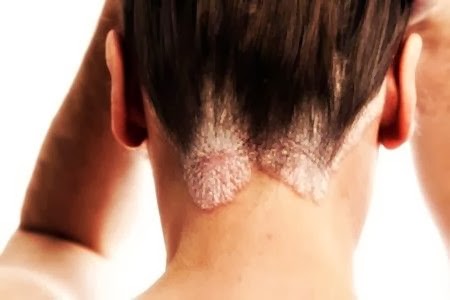 Olio di abete da risposte di psoriasi